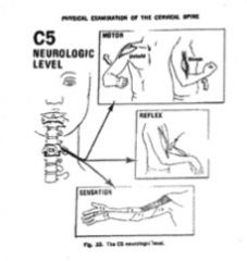 Bicipital
Contraction flex coude et ABD épaule