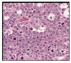 Sheets of tumor cells characterized by lymphocytes with large cell size, round to irregular nuclear contours, vesicular chromatin, multiple distinct eosinophilic nucleoi, and moderate amounts of eosinophilic cytoplasm.