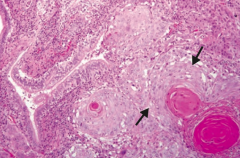 Squamous Cell Carcinoma
- Keratin pearls and intercellular bridges
- Sheets of large dysplastic squamous cells (arrows) surrounding dark, pink keratin pearls (lower right)