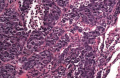 Small Cell (Oat Cell) Carcinoma
- Sheets of dark purple tumor cells with nuclear molding, high mitotic rate, necrosis, and "salt and pepper" neuroendocrine-type chromatin
- Neoplasm of neuroendocrine Kulchitsky cells → small dark blue cells