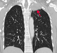 What type of lung cancer occurs in the apex of the lung? What can it do?
