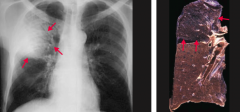 Intra-alveolar exudate → consolidation
- May involve entire lung
