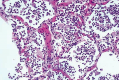 Neutrophils in alveolar space