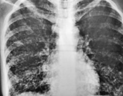 What does this chest x-ray show?