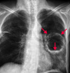 What does this chest x-ray show?