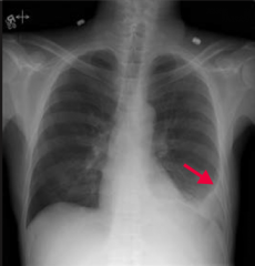 What does this chest x-ray show? How would you describe it?