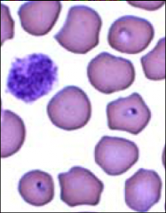 - piroplasms in RBCs on blood smear (only in late disease)
- schizonts in aspirates or smears of spleen, lymph nodes, or bone marrow
- PCR (important in early infection)