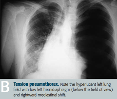 - Air is capable of entering pleural space but not exiting
- Trachea deviates AWAY from the affected lung
- Usually occurs in setting of trauma or lung infection