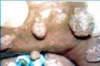 what benign epithelial tumour is this? what can it be a manifestation of?