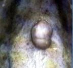 whats benign connective tissue tumour is this? what does it feel like? whats it usual appearance? whats the treatment?