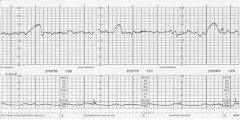 Test of fetal well-being. Considered reactive (healthy) if there are two accelerations of the FHR in 20 minutes that are at least 15 beats above the baseline heart rate and last for at least 15 seconds.


* fetal heart rate variability is a heal...