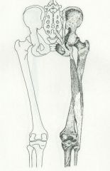 Ischial tuberosity and linea aspera of femur