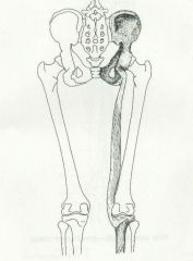 Medial condyle of tibia