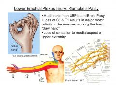Klumpke's palsy:  lower roots of  brachial plexus (C8-T1) *- intrinsic muscles of the hand (interossei, thenar and hypothenar muscles) and the flexors of the wrist / fingers (flexor carpi ulnaris and ulnar half of the flexor digitorum profundus)...