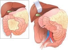 Kocher manoeuvre: to expose structures in the retroperitoneum behind the duodenum and pancreas; for example to control hemorrhage from the inferior vena cava or aorta, or to facilitate removal of a pancreatic tumour.*- peritoneum is incised @ R ed...
