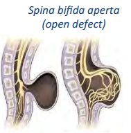 Spina bifida aperta
Meerdere wervelbogen niet goed
Vliezen (evt met ruggenmerg/wortels)stulpen naar buiten
Meningo(myelo)cele (myelo = ruggenmerg, cele = uitstulping)