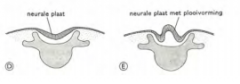 Neurale buis niet gevormd
Myeloschisis
Neuraal weefsel ligt open