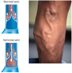 These valves can sometimes fail and when they fail blood can back up (pool) in veins and they can be stretched 
Varicose veins - treatable 
Not muscularized and gravity as it pulls blood back down it closes the valve (in a normal vein) - if this...