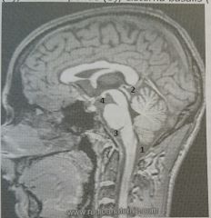 (1) Caudaal van het cerebellum, liquorpunctie mogelijk door achterhoofdsgat