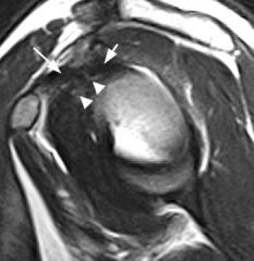 most cases of adhesive capsulitis are idiopathic, risk factors include: females, age 40-60, and some medical conditions such as diabetes and hypothyroidism. It causes a restricted intra-capsular volume, pain, and global loss of motion. Loss of bot...