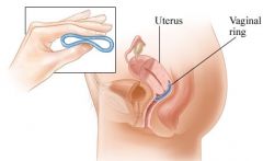 - thin flexible plastic ring
- works for 3 weeks then removed for 1 week to allow menstruation
- Avoids first pass effect
- S/E: vaginal infection/irritation, vaginal discharge
- may have better cycle control, i.e. decreased breakthrough bleeding