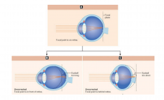 Label the refraction designation for each of the schematic drawings of the eye.