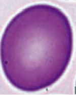 Macro-Ovalocyte
- Megaloblastic anemia (also associated with hypersegmented PMNs)
- Marrow failure