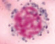 Ringed Sideroblast
- Sideroblastic anemia
- Excess iron in mitochondria = pathologic
