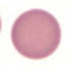 Spherocyte
- Hereditary spherocytosis
- Auto-immune hemolysis