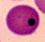 Howell-Jolly Bodies
- Basophilic nuclear remnants found in RBCs
- Normally removed from RBCs by splenic macrophages
* Seen in patients with functional hyposplenia or asplenia