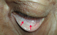 What is the most likely cause of this patient's conjunctival pallor?