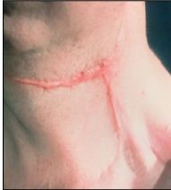 What wound healing complication is seen here