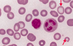 Iron Deficiency Anemia
- Microcytosis
- Hypochromia (central pallor)
