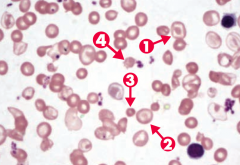 Note anisocytosis, poikilocytosis, target cells (arrows 1 and 2), microcytosis (arrow 3), and schistocytes (arrow 4)