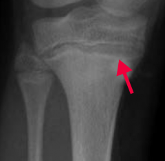 - Lead Lines on metaphyses of long bones on x-ray
- Sign of Lead Poisoning