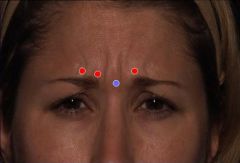 What muscle is involved in making a made face in the eyes and wrinkling the skin b/w the eyes?