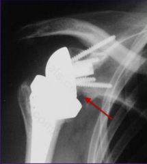 What technical error leads to scapular notching after reverse total shoulder arthroplasty? 1-Sup placement of the glenoid component; 2-Retroverted placement of the glenoid component; 3-Inf placement of the glenoid component; 4-Overtensioning of th...
