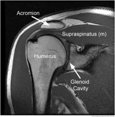 supraspinatus muscle abducts arm at shoulder. runs at superior part of the scapula
