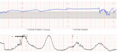 Normal fetal heart rate with good variability and regular contractions
	B.	Fetal tachycardia with good variability and regular contractions
	C.	Normal fetal heart rate with poor variability and irregular contractions
	D.	Fetal tachycardia with ...