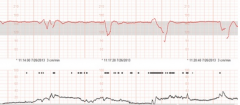 A. Late deceleration
	B. Variable decelerations
	C. Early decelerations
	D. Sinusoidal rhythm
	E. Normal fetal heart rate pattern