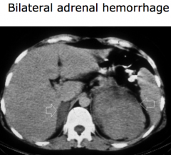 - R adrenal vein drains directly into the posterior aspect of the vena cava
- L adrenal vein drains into the L renal vein before entering the IVC

* Each vein is vulnerable to venous thrombosis and non-traumatic hemorrhage of adrenal glands is ...