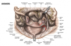 FEMALE INGUINAL CANAL


Females:round ligament of the uterus (from the caudal part of the gubernaculum) 



*cranial part becomes ovarian ligament 



→ So gubernaculum goes from ovary –uterus – inguinal canal – labia majora 



Plus, bloo...