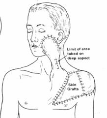 Largely of historic interest
Applications include central neck cutaneous reconstruction, staged pharyngoesophageal reconstruction, and cheek reconstruction