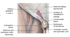 DIRECT INGUINAL HERNIAS

•Directinguinal hernias push directly through the peritoneum→  transversalis fascia → inguinal canal →superficial ringadjacent to the normal inguinal canal contents

•Can bepredisposed if the conjoint tendon is n...