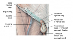 INDIRECT INGUINAL HERNIAS

•Infemales the processusvaginalis also forms the inguinal canal and then normally closes over a period of timeeither before or after birth.

•However,in both males & females the processus vaginalis can remain leaving...