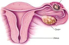 1. Pregnancy that occurs outside of the uterine cavity.


2. The most common site is the ampullas of the fallopian tubes. 95-99% of ectopic pregnancies occur in the fallopian tubes.


3. The incidence of ectopic pregnancies has been increasing...