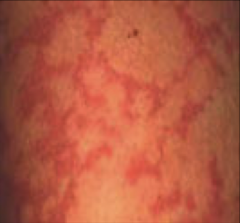 lacy rash
ex: fifths disease