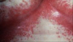 redness, yeast rash in candida
in folds in flexor but could be in groin