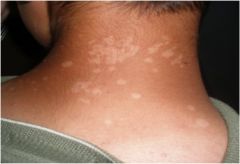 - a circumscribed, flat, nonpalpable, change in skin color
- up to 1 cm 
example: frckles, fat nevi, hypopigmentation tinea, versicolor, petechiae, measles, scarletina rash associate with strep infection