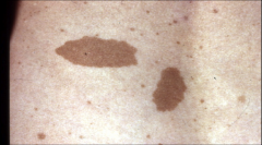 - a macule larger than 1 cm
example: senile lentigo (liver spots), mongolian spot, vitiligo, cafe au lait spot